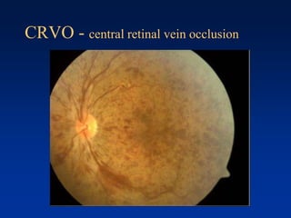 CRVO - central retinal vein occlusion
 
