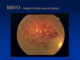 BRVO – branch retinal vein occlusion
 