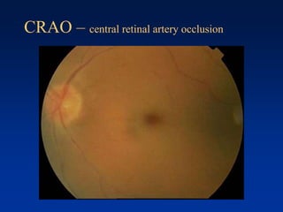 CRAO – central retinal artery occlusion
 