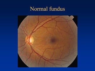 Normal fundus
 