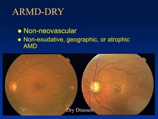 ARMD-DRY
 Non-neovascular
 Non-exudative, geographic, or atrophic
AMD
 Neovascular AMD (Wet)
 Exudative, disciform, or serous AMD
Dry Drussen
 