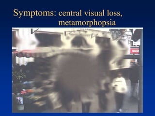 Symptoms: central visual loss,
metamorphopsia
 