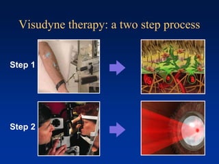 Visudyne therapy: a two step process
Step 1
Step 2
 