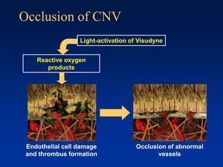 Occlusion of CNV
Reactive oxygen
products
Occlusion of abnormal
vessels
Light-activation of Visudyne
Endothelial cell damage
and thrombus formation
 