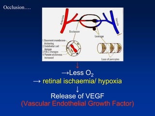 ↓
→Less O2
→ retinal ischaemia/ hypoxia
↓
Release of VEGF
(Vascular Endothelial Growth Factor)
Occlusion….
 