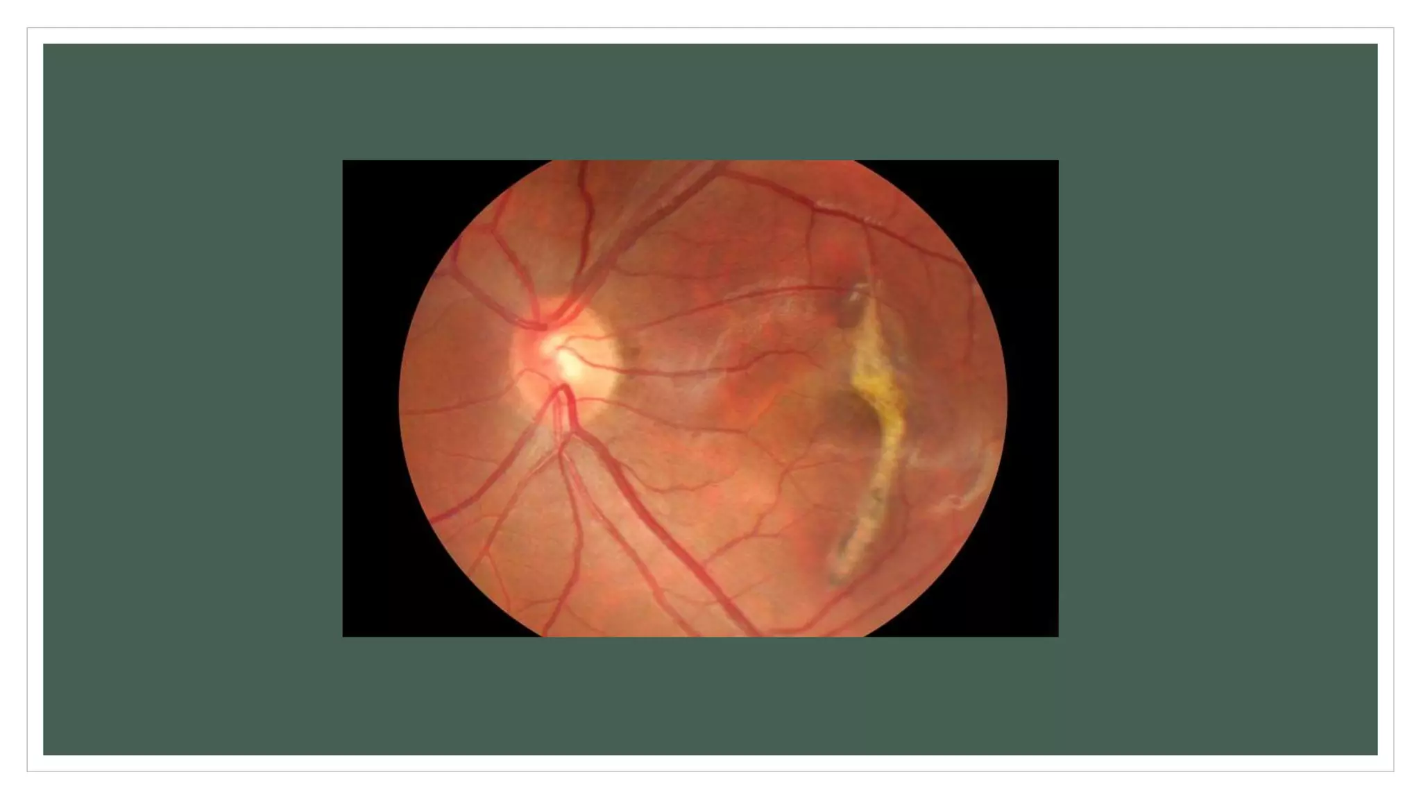 Retinal diseases of eye | PPTX