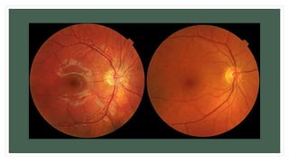 Retinal diseases of eye