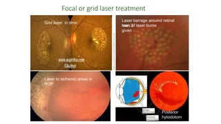 Focal or grid laser treatment
Grid laser in dme
Laser to ischemic areas in
ROP
Posterior
hyloidotom
y
Laser barrage arouind retinal
tear. 3
rows of laser burns
given .
 
