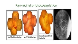 Pan-retinal photocoagulation
 