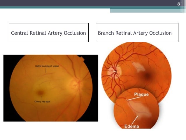 Retinal occlusion