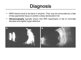 Retinal pigmented fundus | PDF