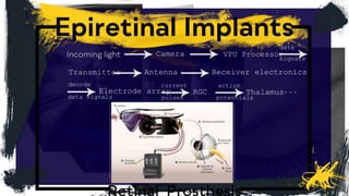 Camera
signals
VPU Processor
data
Transmitter Antenna Receiver electronics
decode
data signals
Electrode array
current
pulses
RGC
action
potentials
Thalamus...