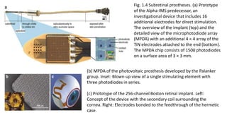 Fig. 1.4 Subretinal prostheses. (a) Prototype
of the Alpha-IMS predecessor, an
investigational device that includes 16
additional electrodes for direct stimulation.
The overview of the implant (top) and the
detailed view of the microphotodiode array
(MPDA) with an additional 4 × 4 array of the
TiN electrodes attached to the end (bottom).
The MPDA chip consists of 1500 photodiodes
on a surface area of 3 × 3 mm.
(b) MPDA of the photovoltaic prosthesis developed by the Palanker
group. Inset: Blown-up view of a single stimulating element with
three photodiodes in series.
(c) Prototype of the 256-channel Boston retinal implant. Left:
Concept of the device with the secondary coil surrounding the
cornea. Right: Electrodes bonded to the feedthrough of the hermetic
case.
 