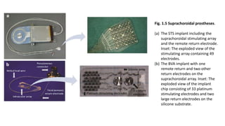 Fig. 1.5 Suprachoroidal prostheses.
(a) The STS implant including the
suprachoroidal stimulating array
and the remote return electrode.
Inset: The exploded view of the
stimulating array containing 49
electrodes.
(b) The BVA implant with one
remote return and two other
return electrodes on the
suprachoroidal array. Inset: The
exploded view of the implant
chip consisting of 33 platinum
stimulating electrodes and two
large return electrodes on the
silicone substrate.
 