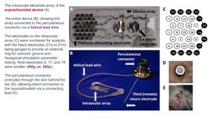 The intraocular electrode array of the
suprachoroidal device (A)
the entire device (B), showing the
array connected to the percutaneous
connector via a helical lead wire.
The electrodes on the intraocular
array (C) were numbered for analysis,
with the black electrodes (21a to 21m)
being ganged to provide an external
ring for common ground and
hexagonal stimulation parameter
testing. Note electrodes 9, 17, and 19
were smaller (400µ vs. 600µ).
The percutaneous connector
protruded through the skin behind the
ear (D), allowing direct connection to
the neurostimulator via a connecting
lead (E).
 