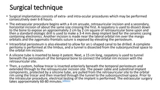 Surgical technique
• Surgical implantation consists of extra- and intra-ocular procedures which may be performed
consecutively over 6-8 hours.
• The extraocular procedure begins with a 4 cm arcuate, retroauricular incision and a secondary,
horizontal incision of about the same size crossing the first. A raspatory is used to dissect down
to the bone to expose an approximately 2 cm by 2 cm square of retroauricular bone upon and
then a standard otologic drill is used to make a 3-4 mm deep implant bed for the ceramic casing
containing electronics. Another incision is made near the lateral orbital rim over the margo
orbitalis and the zygomatic-frontalis suture is exposed by elevating the periosteum.
• Intraorbital periosteum is also elevated to allow for an L-shaped canal to be drilled. A complete
peritomy is performed at the limbus, and a tunnel is dissected from the subconjunctival space to
the orbital rim incision.
• A silicone tube is inserted to keep it patent. Next, a 15 cm long, raspatory is used to tunnel
beneath the periosteum of the temporal bone to connect the orbital rim incision with the
retroauricular site.
• Then, a custom, hollow trocar is inserted anteriorly beneath the temporal periosteum and
extended through to the retroauricular incision site. The power cable and subretinal implant
components, protected by a silicone tube, are pulled from the retroauricular site to the orbital
rim using the trocar and then inserted through the tunnel to the subconjunctival space. Prior to
the intraocular procedure, electrical testing of the implant is performed. The extraocular surgery
takes approximately 60-80 minutes.[20][21]
 