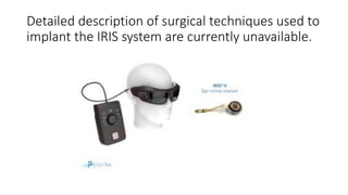 Detailed description of surgical techniques used to
implant the IRIS system are currently unavailable.
 