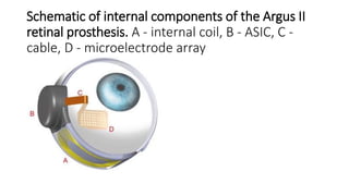 Schematic of internal components of the Argus II
retinal prosthesis. A - internal coil, B - ASIC, C -
cable, D - microelectrode array
 