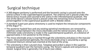 Surgical technique
• A 360-degree peritomy is performed and the hermetic casing is sutured onto the
scleral surface in the superotemporal quadrant. The antenna coil is placed under the
lateral rectus muscle and sutured to the sclera in the inferotemporal quadrant. The
rest of the device’s silicone band is placed under the remaining rectus muscles and
joined together in the superonasal quadrant with a Watzke sleeve.
• A standard 3-port pars plana vitrectomy is used to implant the intraocular components
of the Argus® II .
• The posterior hyaloid face and any existing epiretinal membranes are removed to
optimize contact between the micro-electrodes and the retinal neurons. Next, a 5.2
millimeter wide sclerotomy is made in the superotemporal quadrant, at a distance of
approximately 3 mm posterior to the limbus.
• The micro-electrode array is inserted through the sclerotomy and place in the macular
region. Once positioned optimally, the micro-electrode array is secured by a spring-
tensioned titanium retinal tack inserted at the heel of the array.
• The sclerotomy is then sutured close. Tutoplast pericardial is place in the superior
temporal quadrant over the hermetic casing. The Tenon’s capsule and conjunctiva is
closed. Surgical time is generally 2 to 4 hours (see video).
 