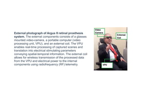 External photograph of Argus II retinal prosthesis
system. The external components consists of a glasses
mounted video-camera, a portable computer (video
processing unit, VPU), and an external coil. The VPU
enables real-time processing of captured scenes and
translation into electrical stimulating parameters
conveying spatial-temporal information. The external coil
allows for wireless transmission of the processed data
from the VPU and electrical power to the internal
components using radiofrequency (RF) telemetry.
 