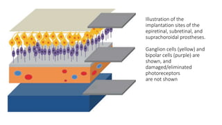 Illustration of the
implantation sites of the
epiretinal, subretinal, and
suprachoroidal prostheses.
Ganglion cells (yellow) and
bipolar cells (purple) are
shown, and
damaged/eliminated
photoreceptors
are not shown
 