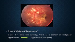 • Grade 4 ‘Malignant Hypertension’:
Grade 3 + optic disc swelling, which is a marker of ‘malignant’
hypertension Hypertensive emergency
 