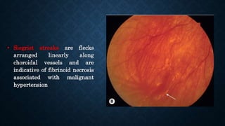 • Siegrist streaks are flecks
arranged linearly along
choroidal vessels and are
indicative of fibrinoid necrosis
associated with malignant
hypertension
 