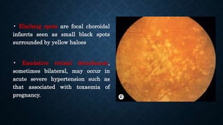 • Elschnig spots are focal choroidal
infarcts seen as small black spots
surrounded by yellow haloes
• Exudative retinal detachment,
sometimes bilateral, may occur in
acute severe hypertension such as
that associated with toxaemia of
pregnancy.
 