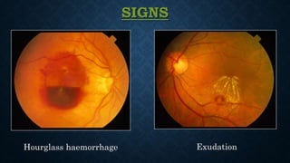 SIGNS
Hourglass haemorrhage Exudation
 