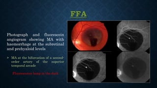 FFA
Photograph and fluorescein
angiogram showing MA with
haemorrhage at the subretinal
and prehyaloid levels
˃ MA at the bifurcation of a second-
order artery of the superior
temporal arcade
Fluorescence lamp in the dark
 