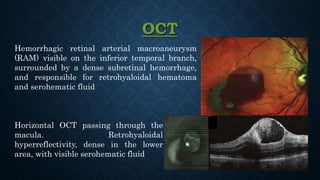 OCT
Hemorrhagic retinal arterial macroaneurysm
(RAM) visible on the inferior temporal branch,
surrounded by a dense subretinal hemorrhage,
and responsible for retrohyaloidal hematoma
and serohematic fluid
Horizontal OCT passing through the
macula. Retrohyaloidal
hyperreflectivity, dense in the lower
area, with visible serohematic fluid
 