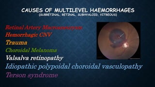 CAUSES OF MULTILEVEL HAEMORRHAGES
(SUBRETINAL, RETINAL, SUBHYALOID, VITREOUS)
Retinal Artery Macroaneurysm
Hemorrhagic CNV
Trauma
Choroidal Melanoma
Valsalva retinopathy
Idiopathic polypoidal choroidal vasculopathy
Terson syndrome
 