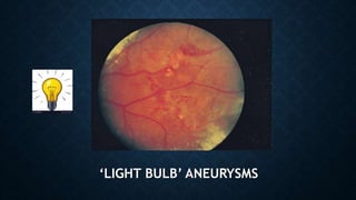 ‘LIGHT BULB’ ANEURYSMS
 