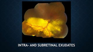 INTRA- AND SUBRETINAL EXUDATES
 