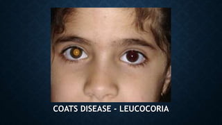 COATS DISEASE - LEUCOCORIA
 
