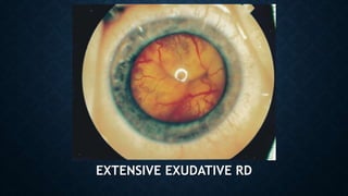 EXTENSIVE EXUDATIVE RD
 