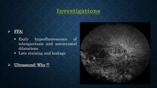 Investigations
 FFA:
 Early hyperfluorescence of
telangiectasis and aneurysmal
dilatations
 Late staining and leakage
 Ultrasound: Why ?!
 