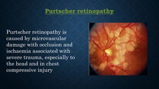 Purtscher retinopathy
Purtscher retinopathy is
caused by microvascular
damage with occlusion and
ischaemia associated with
severe trauma, especially to
the head and in chest
compressive injury
 