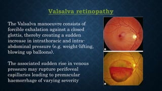 Valsalva retinopathy
The Valsalva manoeuvre consists of
forcible exhalation against a closed
glottis, thereby creating a sudden
increase in intrathoracic and intra-
abdominal pressure (e.g. weight-lifting,
blowing up balloons).
The associated sudden rise in venous
pressure may rupture perifoveal
capillaries leading to premacular
haemorrhage of varying severity
 