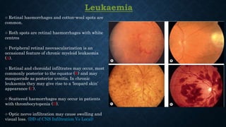Leukaemia
○ Retinal haemorrhages and cotton-wool spots are
common.
○ Roth spots are retinal haemorrhages with white
centres
○ Peripheral retinal neovascularization is an
occasional feature of chronic myeloid leukaemia
(A).
○ Retinal and choroidal infiltrates may occur, most
commonly posterior to the equator (B) and may
masquerade as posterior uveitis. In chronic
leukaemia they may give rise to a ‘leopard skin’
appearance (C).
○ Scattered haemorrhages may occur in patients
with thrombocytopenia (D).
○ Optic nerve infiltration may cause swelling and
visual loss. (DD of CNS Infiltration Vs Local)
 