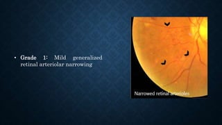 • Grade 1: Mild generalized
retinal arteriolar narrowing
 
