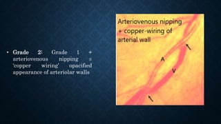 • Grade 2: Grade 1 +
arteriovenous nipping ±
‘copper wiring’ opacified
appearance of arteriolar walls
 