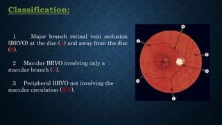 Classification:
1 Major branch retinal vein occlusion
(BRVO) at the disc (A) and away from the disc
(B).
2 Macular BRVO involving only a
macular branch (C).
3 Peripheral BRVO not involving the
macular circulation (D-F).
 
