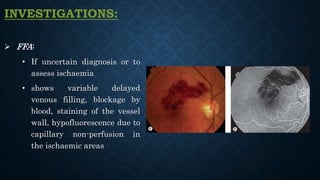  FFA:
• If uncertain diagnosis or to
assess ischaemia
• shows variable delayed
venous filling, blockage by
blood, staining of the vessel
wall, hypofluorescence due to
capillary non-perfusion in
the ischaemic areas
INVESTIGATIONS:
 
