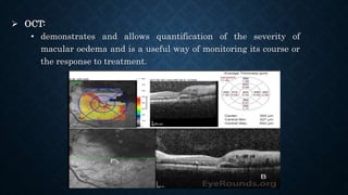  OCT:
• demonstrates and allows quantification of the severity of
macular oedema and is a useful way of monitoring its course or
the response to treatment.
 