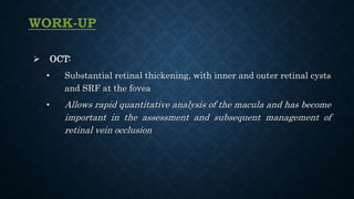 WORK-UP
 OCT:
• Substantial retinal thickening, with inner and outer retinal cysts
and SRF at the fovea
• Allows rapid quantitative analysis of the macula and has become
important in the assessment and subsequent management of
retinal vein occlusion
 