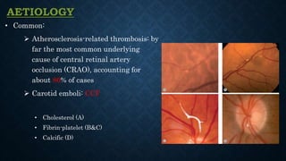 AETIOLOGY
• Common:
 Atherosclerosis-related thrombosis: by
far the most common underlying
cause of central retinal artery
occlusion (CRAO), accounting for
about 80% of cases
 Carotid emboli: CCF
• Cholesterol (A)
• Fibrin-platelet (B&C)
• Calcific (D)
 