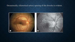 Occasionally, cilioretinal artery sparing of the foveola is evident.
 