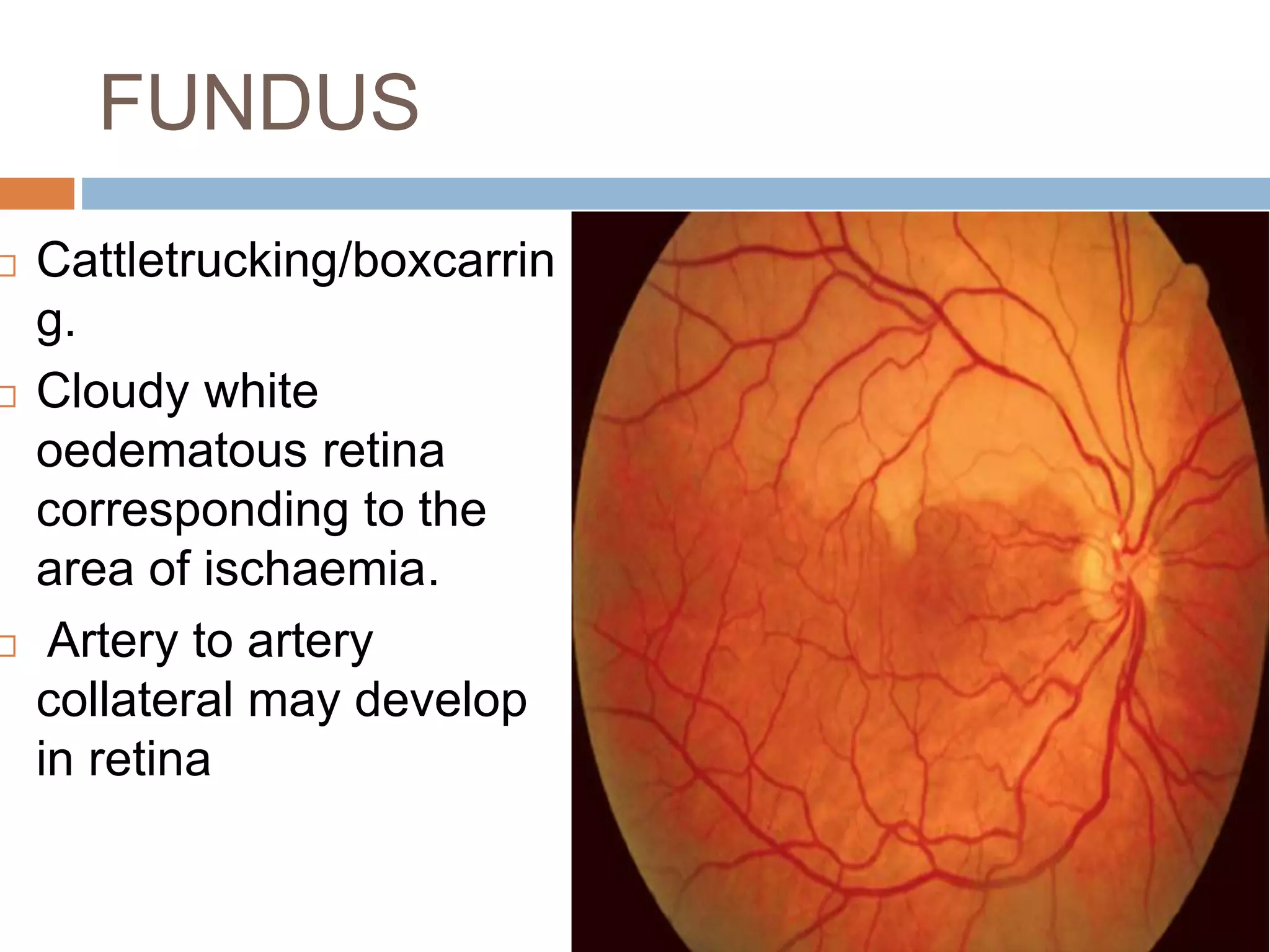 Retinal vascular occlusions | PPTX