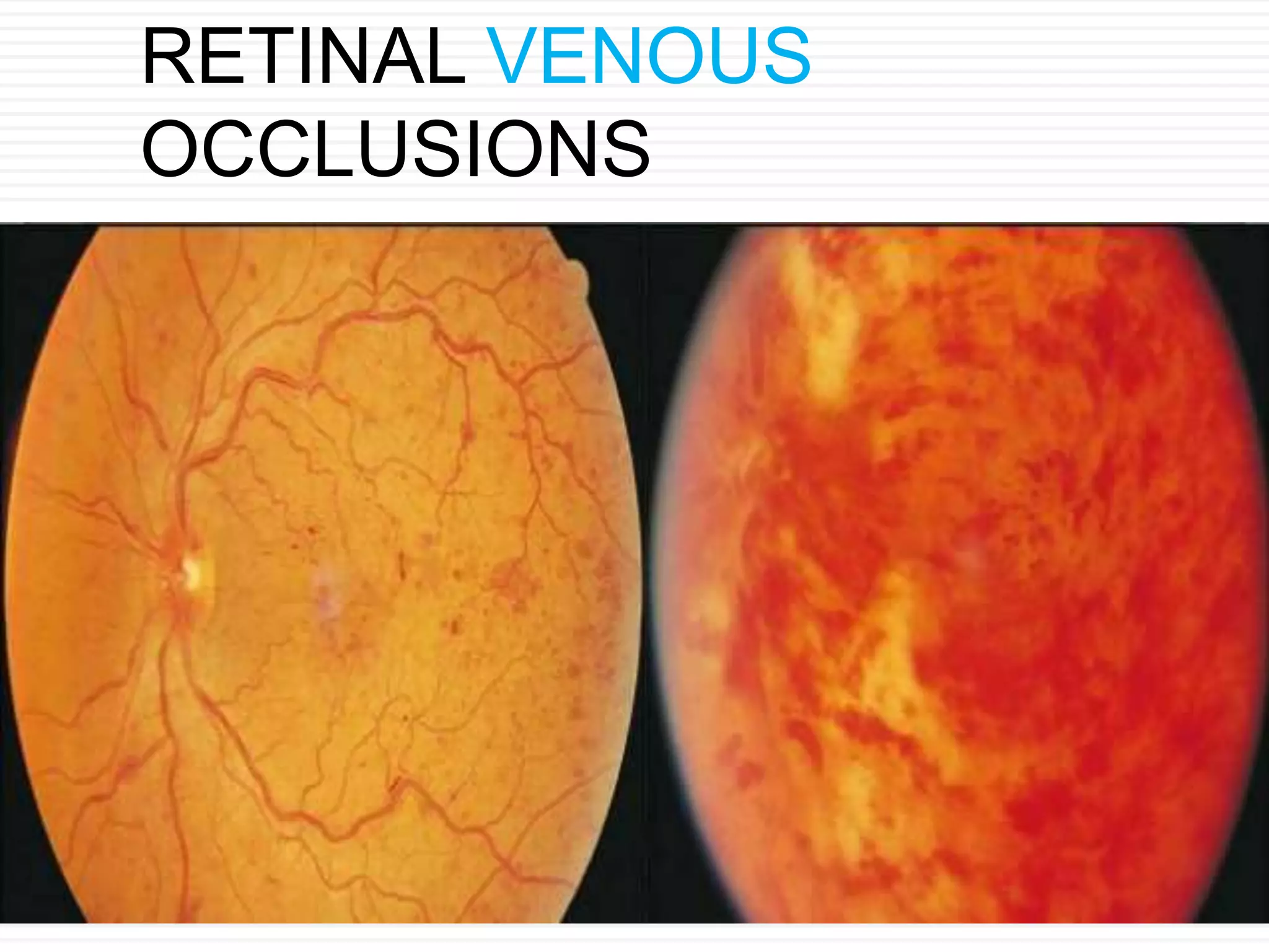 Retinal vascular occlusions | PPTX